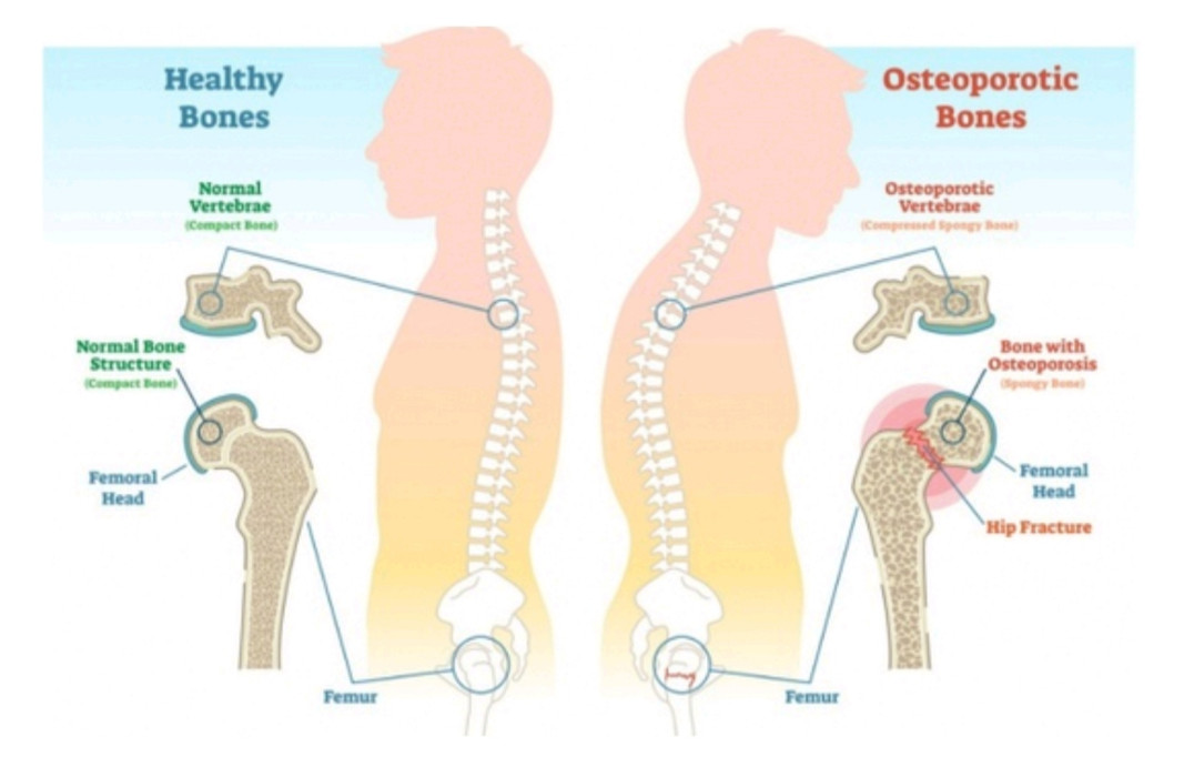 Memperingati Hari Osteoporis Sedunia : Obat Dewa Sebabkan Osteoporosis?